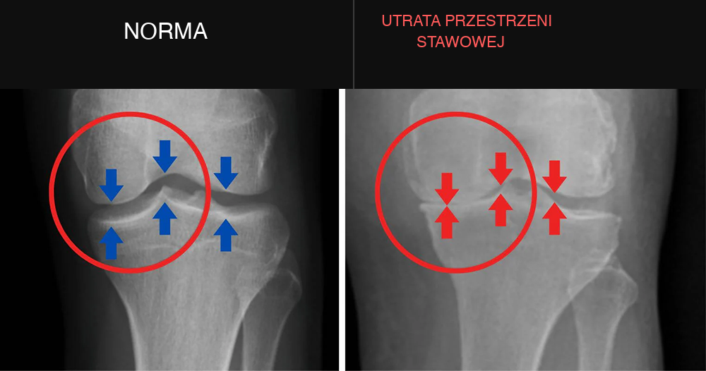 noomkneepro xray pl